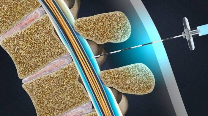 Epidural injection steroid lumbar injections spine implant injecting spinal steriod relieve without orthopaedic treatment orlandoortho