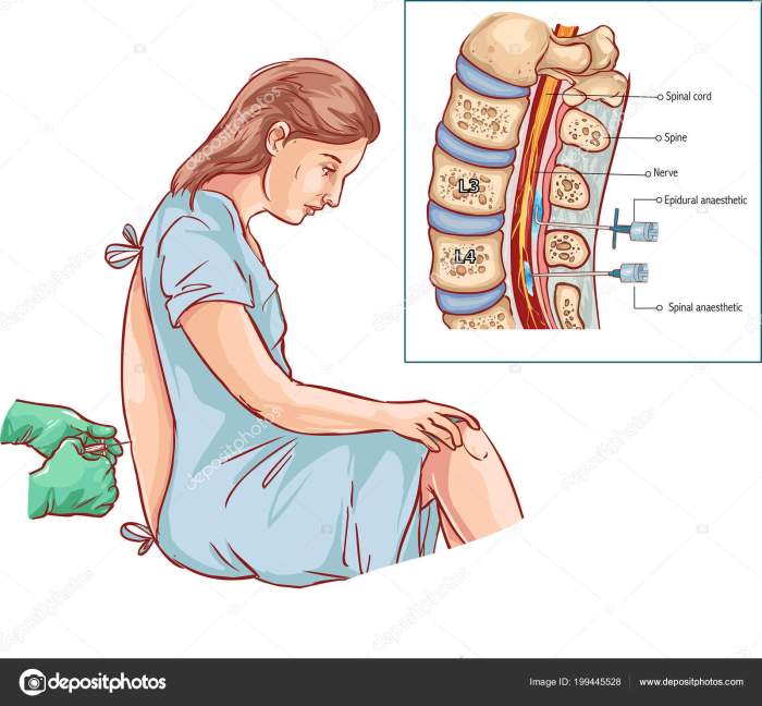 Epidural injection steroid