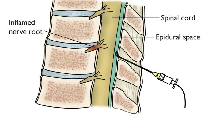 Epidural injection of phenol into c5