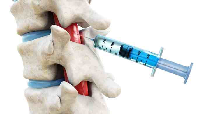 Epidural injection steroid pain sciatica spine surgery spinal back injections management lumbar block stenosis procedure institute care headache guardian herniated